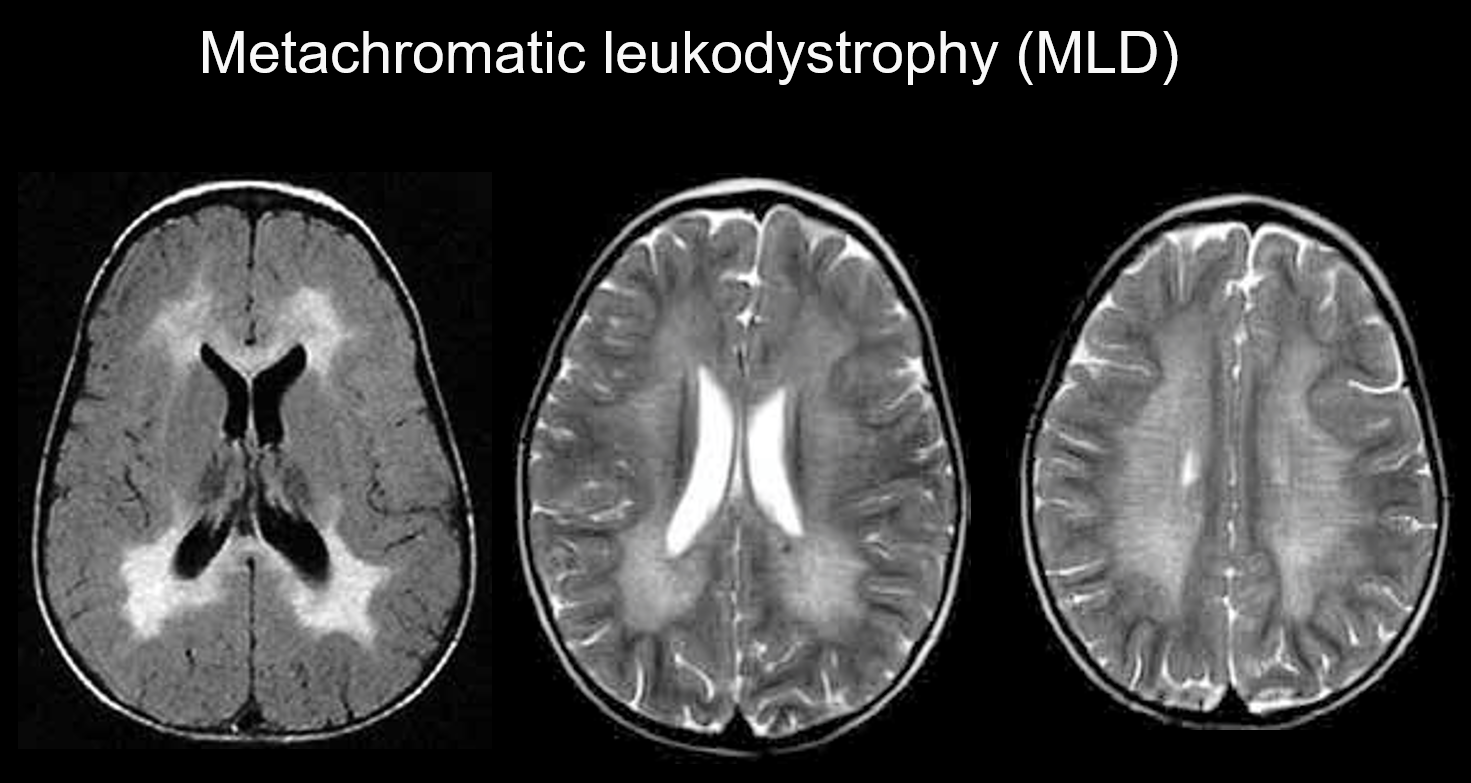 図5. Metachromatic leukodystrophy １歳男性、発達遅滞、痙性麻痺。T2強調画像にて左右対称性に白質の高信号が認められる。皮質下白質は保たれている。白質の異常信号の中に正常信号の線状構造 (tiger stripes) が認められる。（UCSF, Barkovich教授のご厚意による）